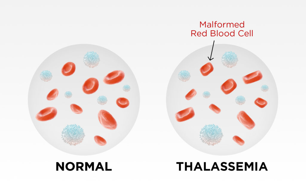 Thalassaemia & Whole Body Vibration - The State of the Research 3