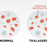 Thalassaemia & Whole Body Vibration - The State of the Research 3