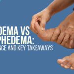 lipedema vs lymphedema