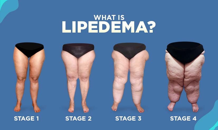 How to Use a Vibration Plate for Lipedema? - Hypervibe UK