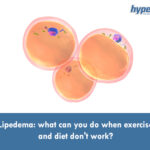 Lipedema what can you do when exercise and diet dont work