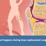 knee replacement surgery