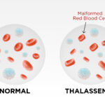 Thalassemia