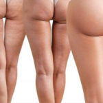 how to manage cellulite