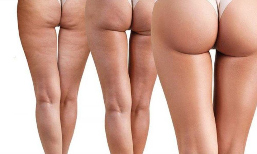 Top 6 Things You Should Know About Cellulite - Muscle & Fitness